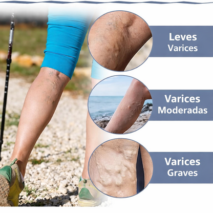 3x1 Parches Naturales para Varices y para las Piernas Cansadas - VeinPatch™