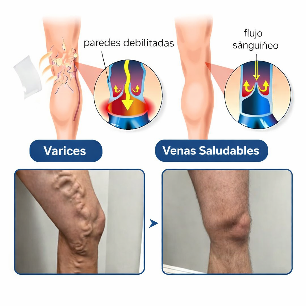 3x1 Parches Naturales para Varices y para las Piernas Cansadas - VeinPatch™