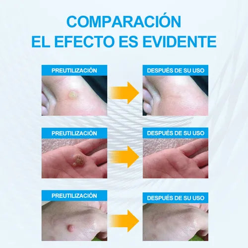 144 Parches Anti Verrugas – Tratamiento Discreto para Verrugas sin dolor